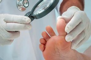 Obdelava plantarnih bradavic
