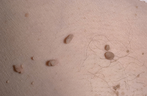 Papiloma