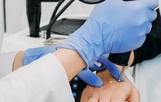 načine za odstranjevanje bradavic