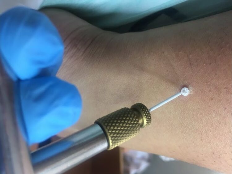 načine za odstranjevanje bradavic