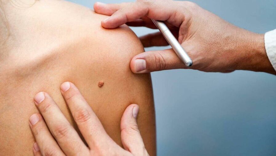 Dermatolog pregleduje bolnika s papilomom