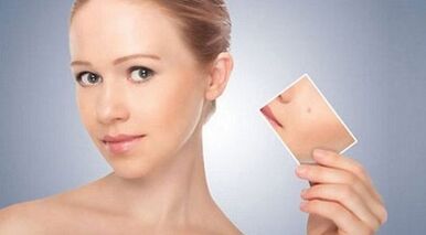 pregled učinkovitih zdravil za bradavice in papilome