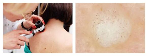 Dermatoskopija bradavice