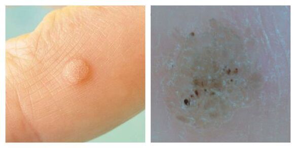 Navadna bradavica med pregledom in dermatoskopijo