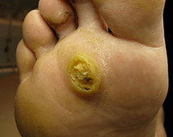 Subanary papilomi